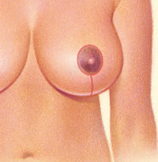 Vertically Down from the Areola, Incision