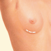 Inframammary Incision