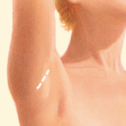 Transaxillary Incision